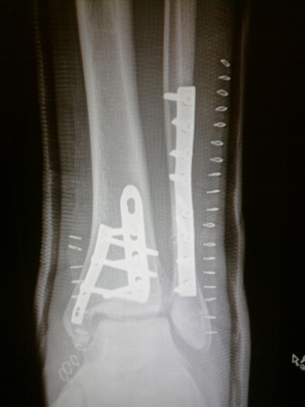 broken tibia and fibula cast