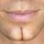 buttchin